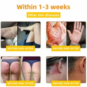 LOVILDS® Bee Venom Comprehensive Cream