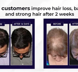 LOVILDS Natural Hair Regrowth Spray