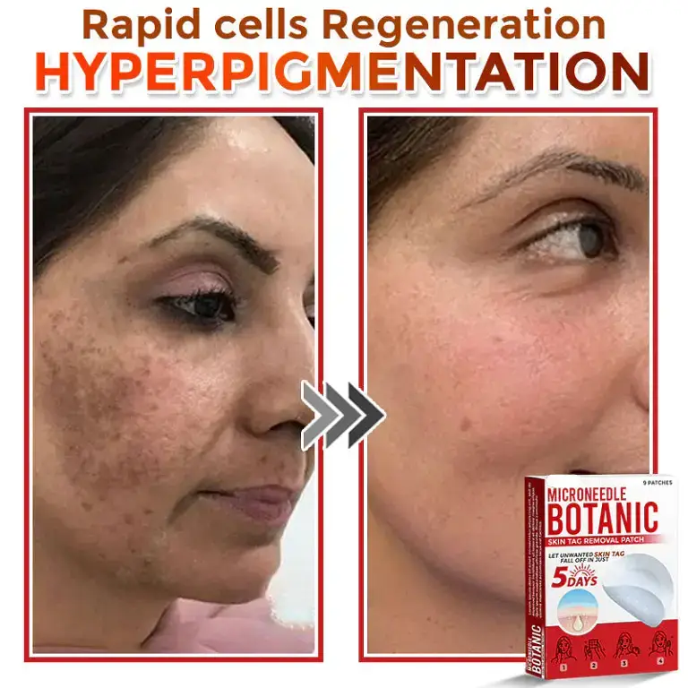 LOVILDS® MicroNeedle Botanic Skin Tag Removal Patch LOVILDS® MicroNeedle Botanic Skin Tag Removal Patch