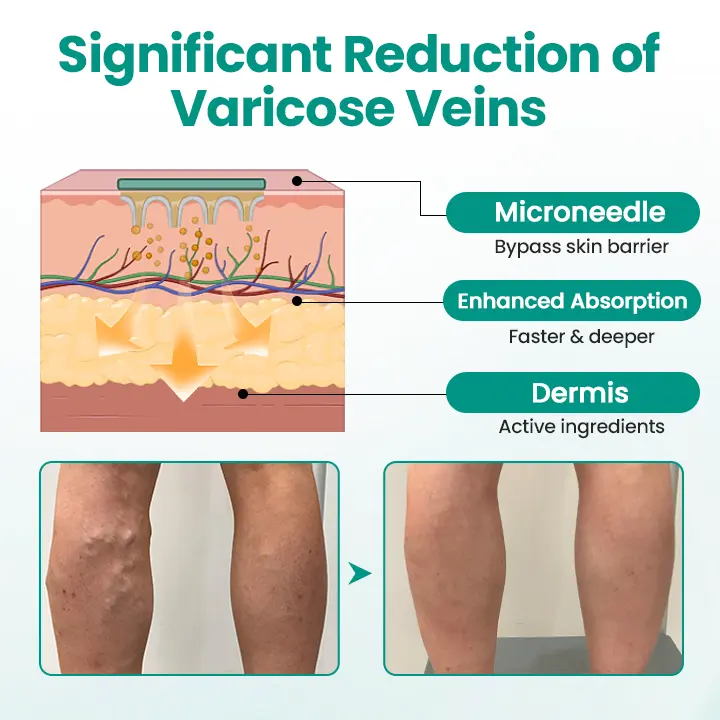 LOVILDS™ LegRenew Varicose Veins Patch