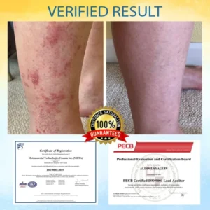 LOVILDS® Psoriasis Care Mellifera Venom Skin Healing Spray