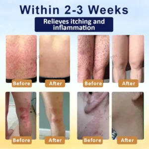 LOVILDS™ Psoriasis Care Mellifera Venom Skin Healing Spray