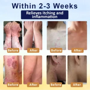 LOVILDS™ Psoriasis Care Mellifera Venom Skin Healing Spray