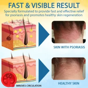 LOVILDS™ Psoriasis Care Mellifera Venom Skin Healing Spray