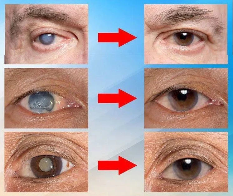 LOVILDS™ Vision Drops — Rapidly Heals All Eye Conditions & Restores Vision