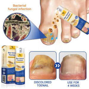 LOVILDS™ PsoriaHeal Spray for psoriasis
